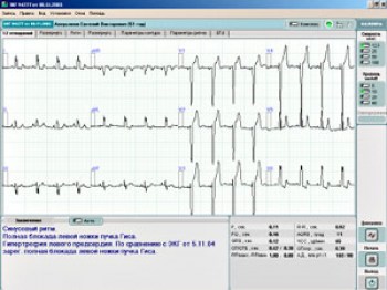 method_ecg_1